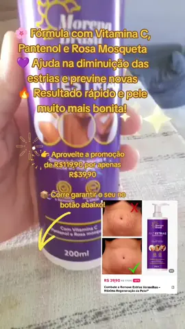 ❌ Estrias marcadas ✅ Pele lisinha em dias! 🔥 AntiEstrias Morena Brasil ✨ Resultado rápido e eficaz #antesedepois #estrias #pelelisinha #autoestima #cuidadoscomapele 