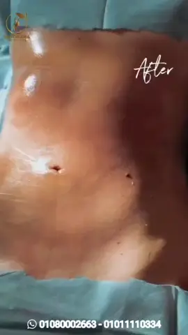 نتيجه شفط الدهون ٣٦٠ ونحت الخصر وحقن المؤخره!؟🔥 مهمتنا كفريق طبي مع  نخبه من افضل الاطباء المحترفه  استشارى جراحه التجميل بعيادات بانورما  اننا نسهل وصولكم لأهدافكم ونساعدك علي تحقيقها كذا صممنا لكم باقات وبرامج مناسبه ومتوفره لكافه الأهداف.🫣 احلمى واتمني وسيبي الباقى علينا☺️❤‍🔥 🇸🇦 🇸🇾🇸🇩🇵🇸🇱🇧🇰🇼🇪🇬🇯🇴🇹🇳🇹🇷🇸🇾 #indoorphotoshoot #mumbai#influencer #trending  #viralvideos                                  للحجز والاستفسار:-01011110334-01080002663
