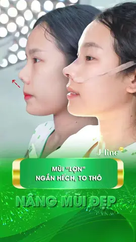 Từ Hàn Quốc bay về giải cứu mũi “lợn” co rút, to thô #jlinekorea #nangmuidouyin #nangmuitrunghoa  #phauthuatthammy #xuhuong 