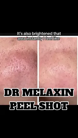 Wow!!! The before and after pictures are blowing my mind, my texture is better, blackheads gone, brighter complexion. Pores smaller! WOW! #drmelaxinpeelshot #peelshot #drmelaxin #skincare #pores @Dr Melaxin Official 