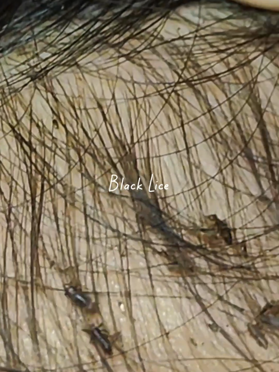 Lice Removal 365 #omg #lice #tripofobia #liceremoval #licetreatment 