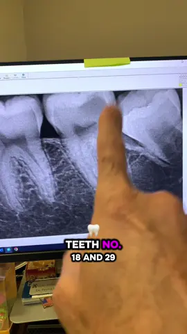 Tiny opening and MTA plugs had to be placed. #dentists #rootcanal #dentistry #dentalstudent #dentalhygienist 