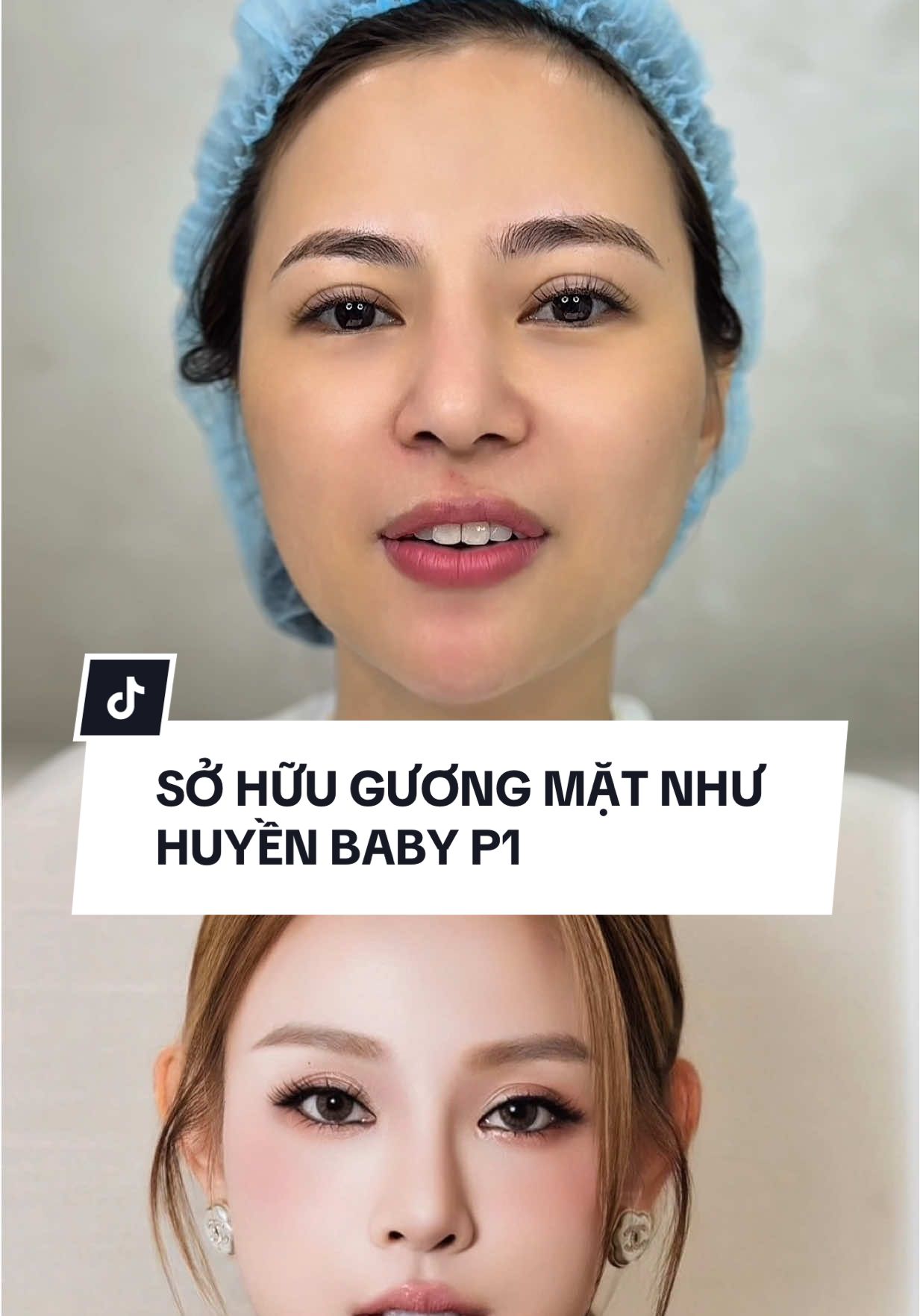 PHẦN 1 HÀNH TRÌNH HOT.GIRL MỸ DUYÊN TRÙNG TU GƯƠNG MẶT HẠ GÒ MÁ+ HÚT MỠ NỌNG CẰM VÀ VIỀN.HÀM.THAY ĐỔI MONG MUỐN SỞ HỮU GƯƠNG MẶT NHƯ HUYỀN BABY CẢ NHÀ CHỜ KẾT QUẢ#phauthuatthammy 