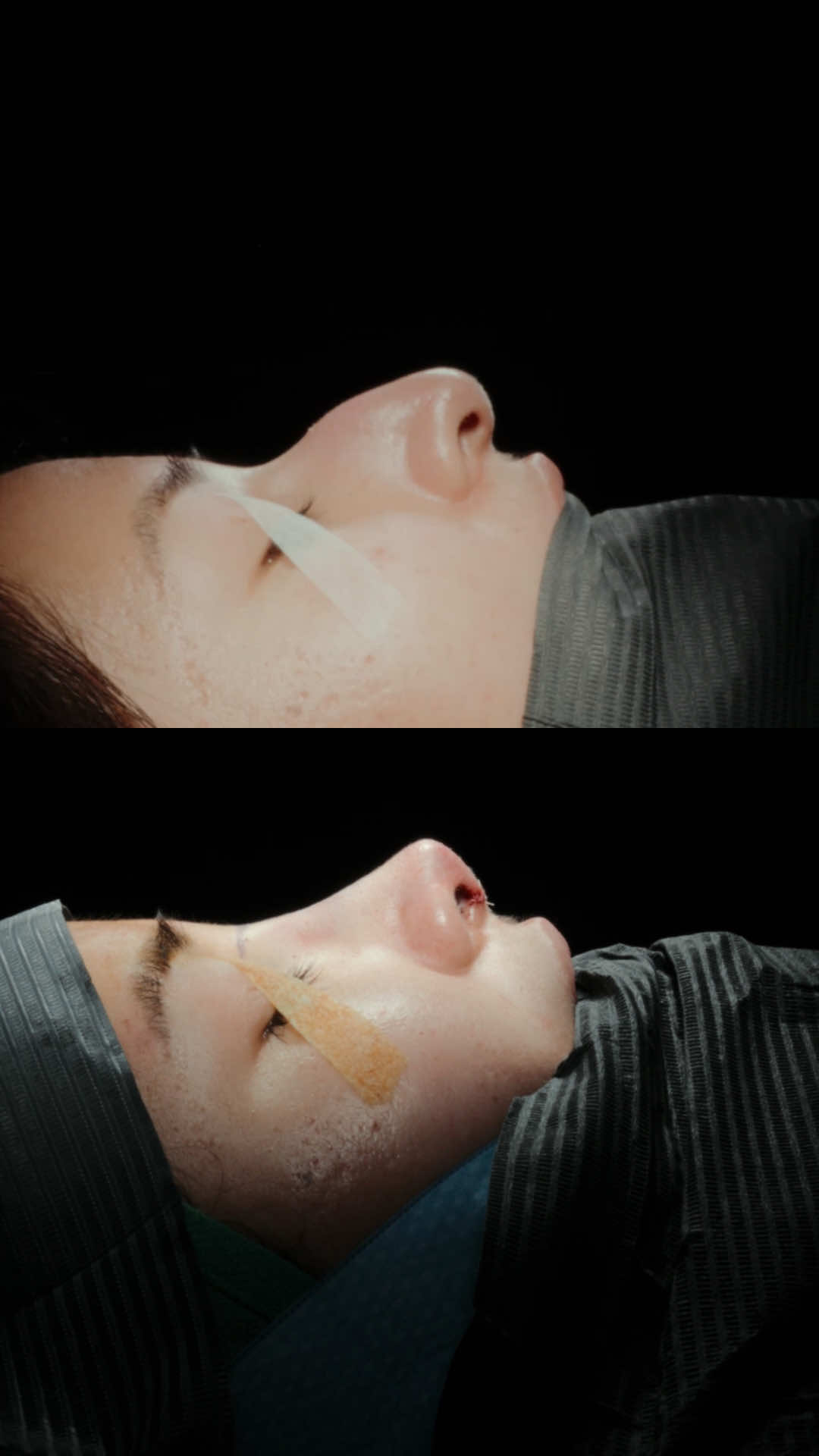 I am so excited for my patient here because this is a change she has been wanting for a long time 💫 She was bothered by the hump on her nose and how it drooped downward, and I am grateful to be part of the chapter that turns the page for her. The nose is at the center of the face, so when something feels off, it can really take attention away from other features. While she does have a smaller chin, her main concern was the nose, and that is exactly what we are focusing on. We are going to soften the profile and straighten it from the front, which will make such a big difference in her overall facial balance and harmony. This is one of those transformations that gets better and better over time, but here is a little on-the-table preview to kick things off 👃🏼✨ 𝙏𝙤 𝙨𝙚𝙚 𝙢𝙚 𝙖𝙨 𝙖 𝙥𝙖𝙩𝙞𝙚𝙣𝙩, 𝙥𝙡𝙚𝙖𝙨𝙚 𝙘𝙤𝙣𝙩𝙖𝙘𝙩 𝙤𝙪𝙧 𝙃𝙤𝙪𝙨𝙩𝙤𝙣 𝙤𝙧 𝙒𝙤𝙤𝙙𝙡𝙖𝙣𝙙𝙨 𝙤𝙛𝙛𝙞𝙘𝙚 𝙖𝙣𝙙 𝙖𝙨𝙠 𝙩𝙤 𝙢𝙖𝙠𝙚 𝙖𝙣 𝙖𝙥𝙥𝙤𝙞𝙣𝙩𝙢𝙚𝙣𝙩 𝙬𝙞𝙩𝙝 𝘿𝙧. 𝙎𝙖𝙣𝙖𝙯, 𝙤𝙧 𝙨𝙥𝙚𝙖𝙠 𝙩𝙤 𝙖 𝙥𝙖𝙩𝙞𝙚𝙣𝙩 𝙘𝙖𝙧𝙚 𝙘𝙤𝙤𝙧𝙙𝙞𝙣𝙖𝙩𝙤𝙧.⁣ ☎️: (713) 202-4232 - Text us 📧: sarahn@myhoustonsurgeons.com 🌎: www.shfacialplastics.com ⠀ Due to high call volume, please leave a message or text us if you are unable to get through, and we will return your call or text promptly.  ⠀ 📍My Houston Surgeons - Memorial Location 9230 Katy Freeway, Ste 600 Houston, TX 77055 📍My Houston Surgeons - The Woodlands Location 18345 S I-45 Frontage Rd Shenandoah, TX 77380 #nosejob #rhinoplasty #houstonplasticsurgeon #houstonfacials