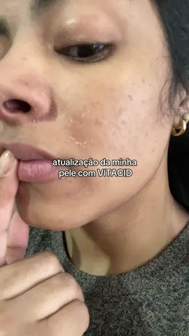 Eu tinha queimado minha pele com vitacid, esperei uns 10 dias para recuperar e voltei e usar! Sinto diferença pouca, mas sei que é um processo lento mesmo, então vou atualizando vocês! 🩷 . Esses dois produtos que usei vocês encontram no mercado livre pelo  ID: 316POX-ELCC  sabonete líquido  ID: 316POX-YJ5T  o ácido hialurônico  . . . #vitacid #cuidadodelapiel  #mercadolivre #meusfavsdomercadolivre 