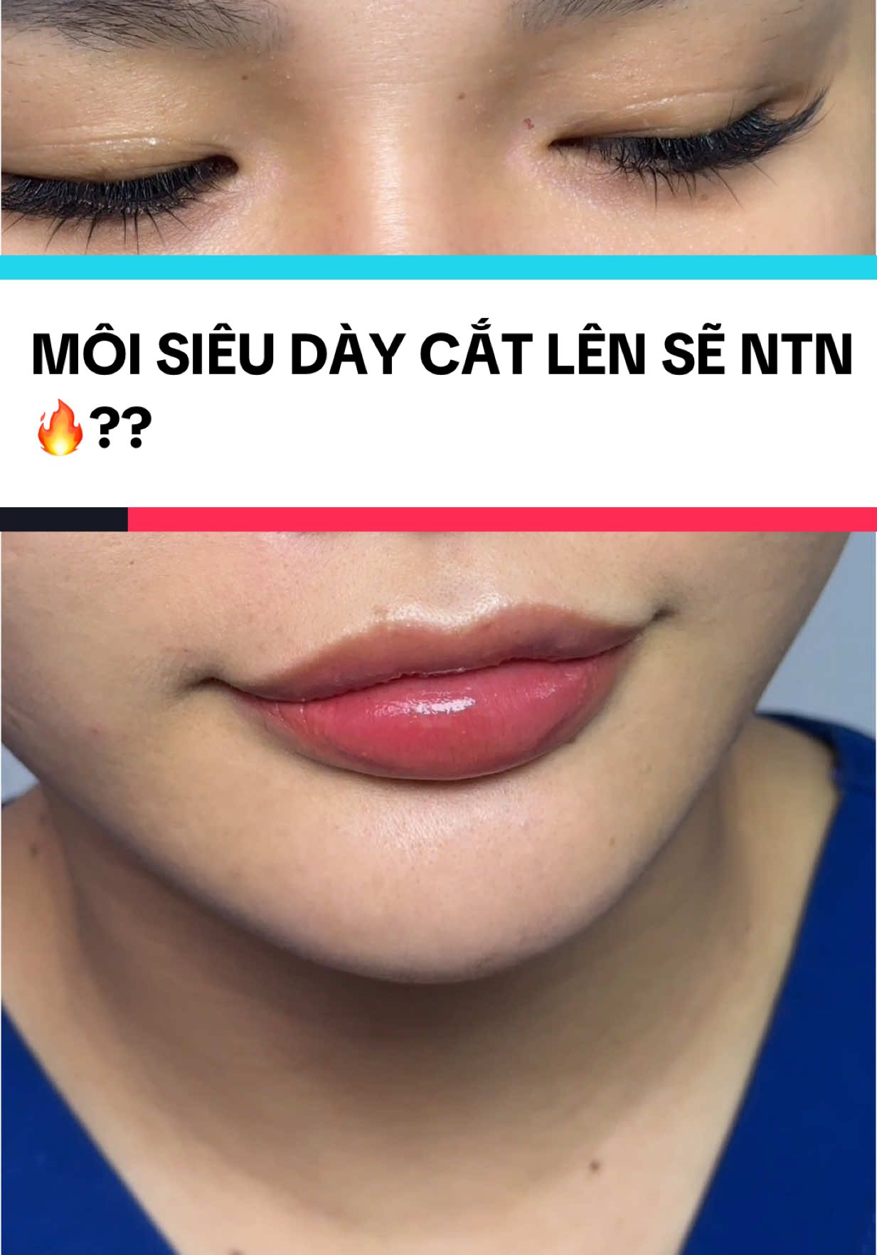 các ca môi dày tiêm filler lỗi dãn da tham khảo phương pháp này nhé ! Vừa hoàn thành xong ko sưng ko bầm xem phom luôn ạ 