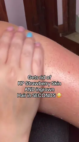 Wow I am amazed at the results of the Dr Melaxin peel shot duo!! @Dr Melaxin Official @Dr.Melaxin Global #drmelaxinpeelshot #strawberryskin #chickenskin #kp #keratosispilaris 