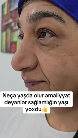 #rinoplastika #burunəməliyyatı #rinoplasty #FYP #global 