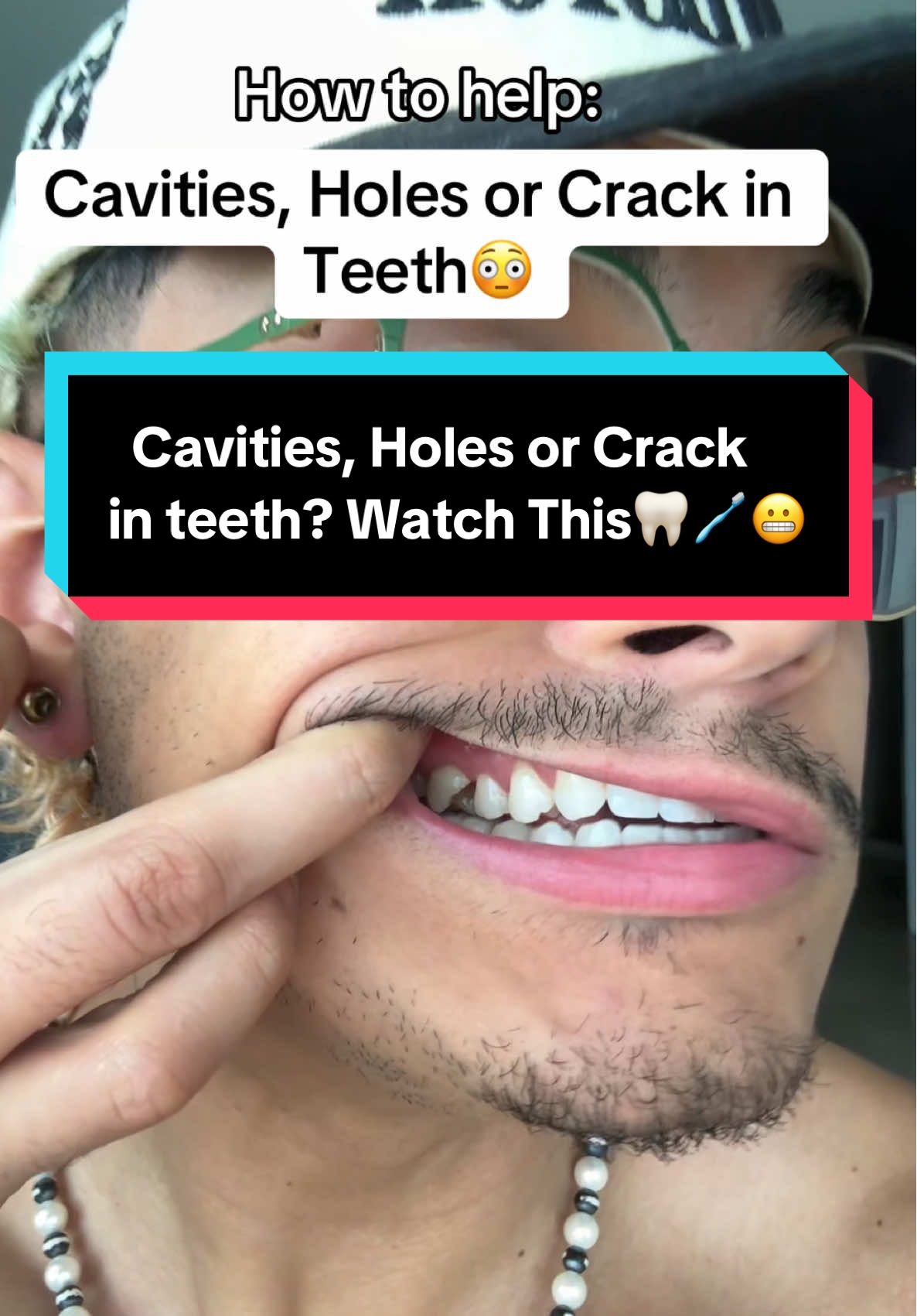 How to help cavities, hole or crack in teeth😭🦷🪥 #nobs #teeth #tooth #toothcare #toothwhitening 