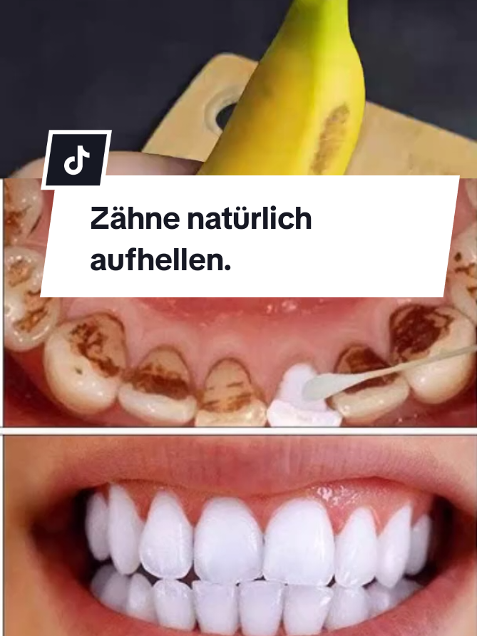 Zähne natürlich aufhellen. Natürliche Zahnaufhellung. Bananenschalen für die Zahnaufhellung. #zähne #zahnaufhellung #naturheilmittel #naturrezepte #deutschland 