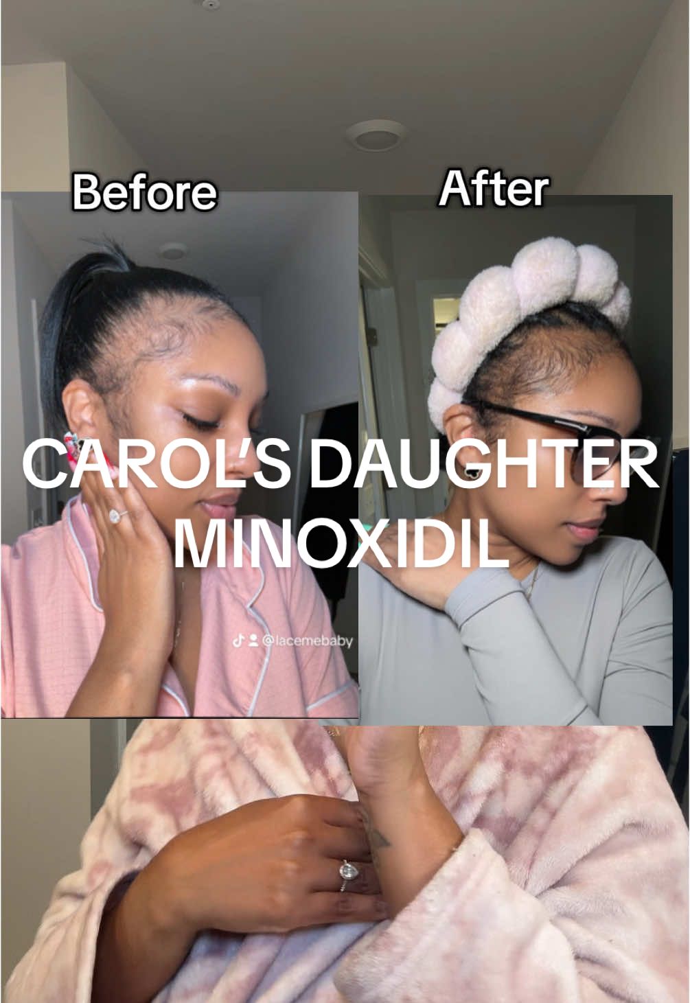 Same regrowth benefits, none of the fear. @Carol’s Daughter NEW 2% Minoxidil = my edges’ new best friend. 💕#CarolsDaughterPartner #tractionalopecia #minoxidil #minoxidilresult #carolsdaughter 