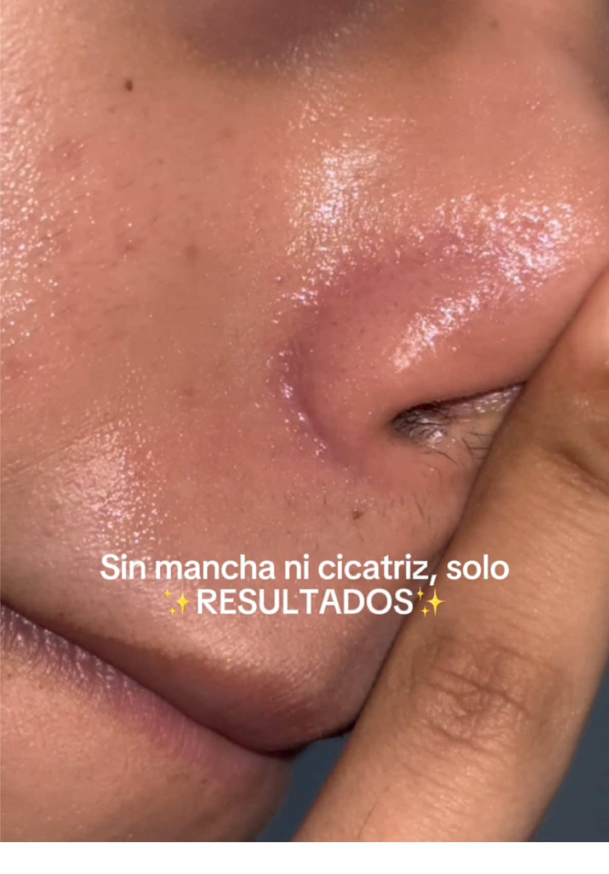 Está disponible en YesStyle con el código de descuento JIMENASDL222 para que te salga más barato, el enlace está en mi perfil y la vas a buscar como Tea-Trica Soot cream  de @SKIN1004 US  #acne #acneskincare #skincare #centella #skin1004   