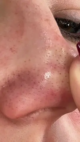 this stuff has never ending uses and literally made my blackheads disappear😭 #drmelaxin #drmelaxinpeelshot #skincare #pores #skincareroutine 