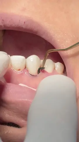 Composite veneer for anterior canine #dentist #dental #dentistry #UK 