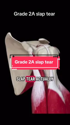 Grade 2A SLAP tear explained in 60 seconds 🩻💪 Shoulder pain, instability and labrum breakdown made simple. Want me to cover Grade 2B next? Drop a comment 👇#shoulder #slaptear #physio #anatomy #LearnOnTikTok 