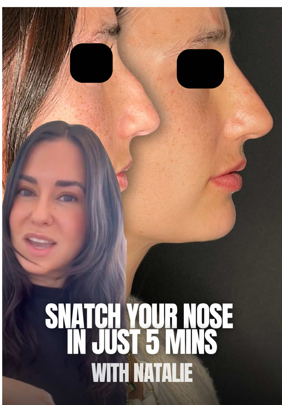 ✨A nose refresh without surgery? I think yes… In this treatment, Nurse Natalie used filler to subtly smooth and lift the nose—camouflaging a small dorsal hump and giving the tip a gentle lift. This non-surgical approach is perfect for patients who want balance and refinement without downtime. Our patient came in feeling self-conscious about the way her nose dipped and bumped on profile. With just a few precise injections, Natalie created a straighter bridge, a lifted tip, and a more harmonious side view. The transformation is natural, subtle, and super impactful—exactly what we aim for with non-surgical rhinoplasty. Ready to love your profile? DM us to schedule your consult today! #nonsurgicalrhinoplasty #liquidnosejob #rhinoplasty  #expertinjector #facialaesthetics 