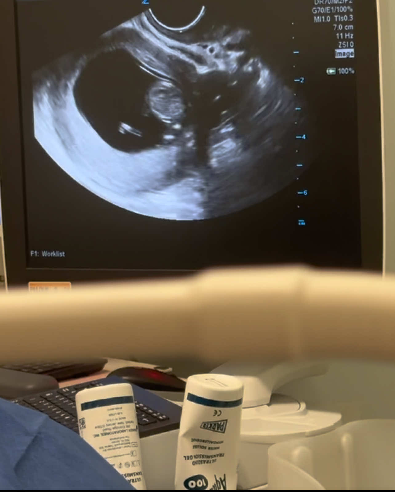 Like it was yesterday🩵 #firsttimemom #ultrasound #10weekspregnant #fyp 