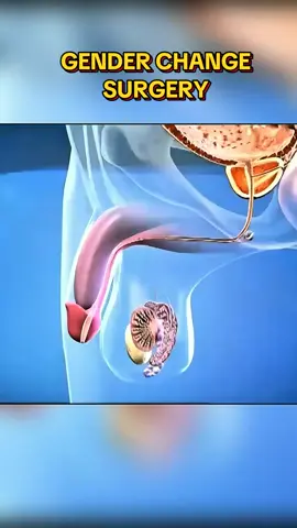 Gender change surgery 3d animations. #genderchange #maletofemale #medicalanimation #healtheducation 