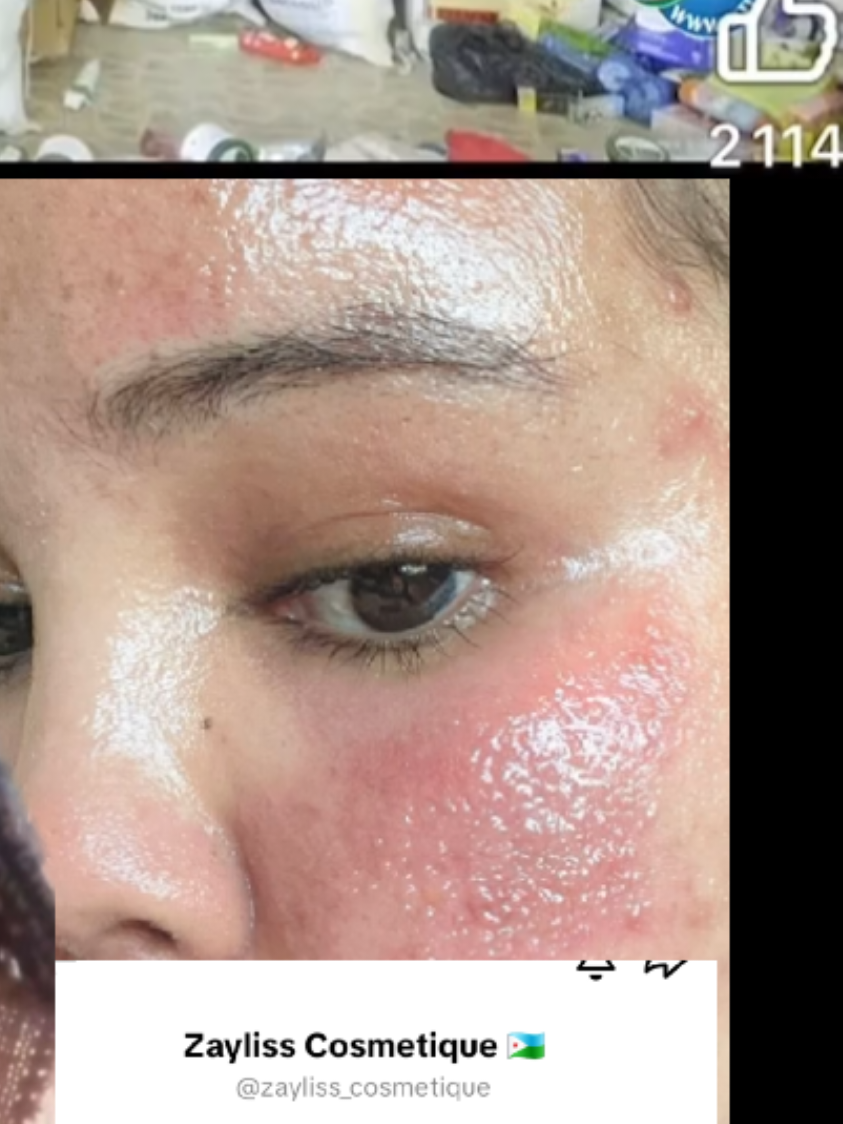 produit éclaircissant interdit à djibouti à cause du cancer de la peau de plus en plus nombreux à l'hôpital peltier@Miguel_AKELA_LOHAN🔥❤️‍🔥♥️👀 @𝓓𝓳_𝓕𝓐𝓘𝓩🤟🔥✈️ @Wayab 🇩🇯🇨🇦🇨🇦 @👑Radwan Said 😎🤑🇩🇯🇸🇴🇸🇪 @Xaqsoor40 🇩🇯❤️🙏🇺🇸 @Asli souban 🇩🇯 @Zaz @GESSIYADA CELEYEH WELLY @bilyaneer ❤️ 