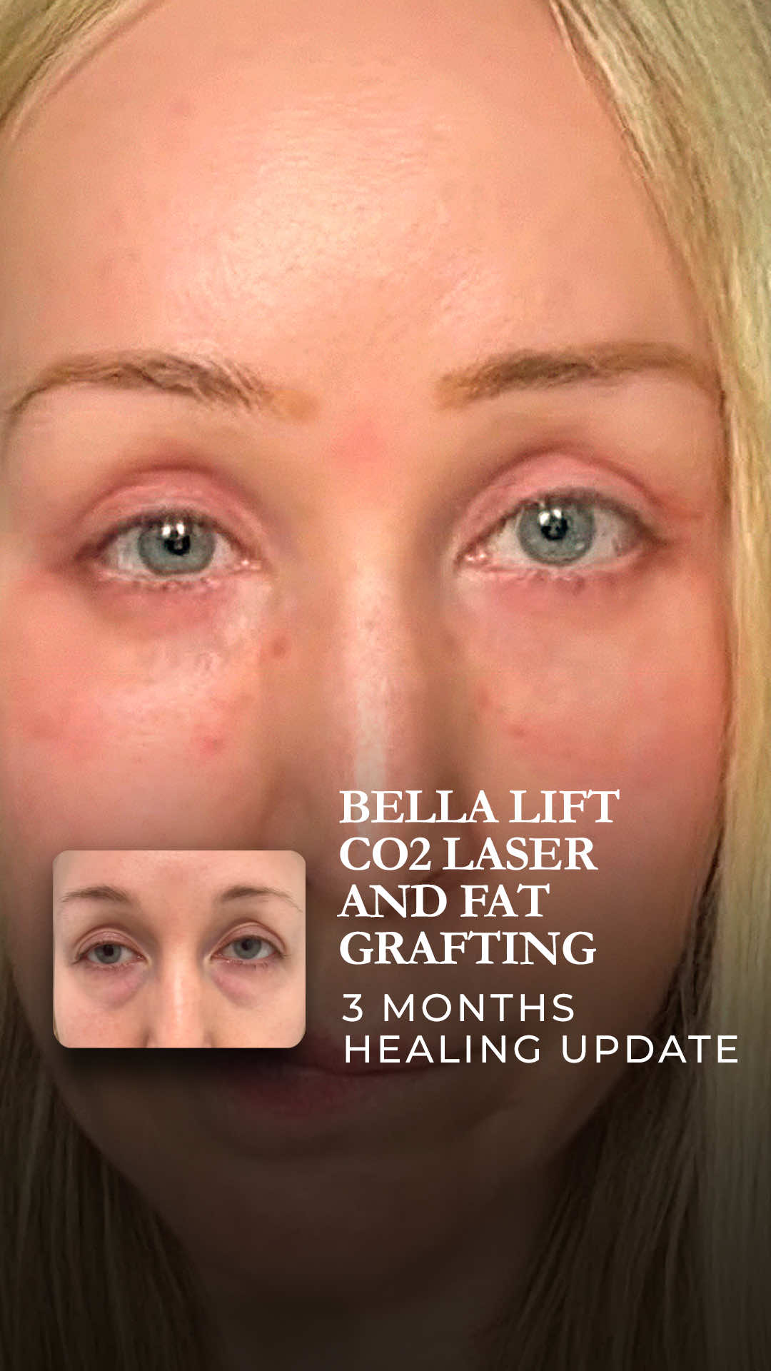 Healing Journey: The Bella Lift  This patient underwent my signature Bella Lift, which combines an endoscopic brow lift, upper & lower eyelid blepharoplasty, C02 laser to the lower lids, and fat grafting to the midface for a complete, natural rejuvenation. In this video, you’ll see 7 days post-op and a virtual follow-up 1 month later, highlighting the healing process and the subtle, refreshed results over time. 💡 Tip: Proper post-op care and follow-ups are key to achieving natural, long-lasting results. 👉 Curious how the Bella Lift can enhance your facial harmony? Comment your questions below or send us a DM! 💬 What’s the first improvement you notice in this patient’s transformation? #BellaLift #BrowLift #Blepharoplasty #FatGrafting #MidfaceRejuvenation         