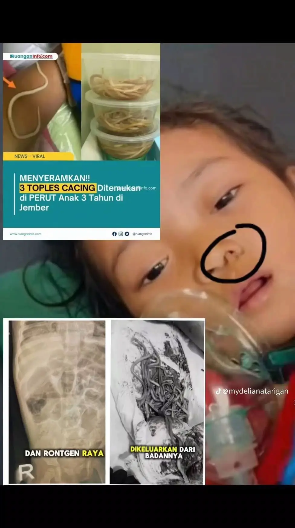 Inalillahi, surga tempatmu nak 🥹... Anak perempuan yg diketahui bernama Raya berumur 4th berasal dari desa kabandungan sukabumi jawabarat. Di dalam tubuh nya di temukan banyak cacing gelang, bahkan hasil CT scan ditemukan ribuan telur cacing yg bersarang di ot** sang anak.  Lebih ngerinya lagi cacing itu keluar dari hidung sang anak , an*s dan kema**an nya. Pelajaran untuk kita para org tua, musibah penyakit tidak ada yg tau. Lebih baik kita mencegah daripada mengobati 🥹🥹🥹. Untuk dek raya surga menantimu nak tenang disana, kamu sudah gak kesa**an lagi. Alfatihah 🤲🤲🤲 #stunting #health #viral #berita #jawabarat  