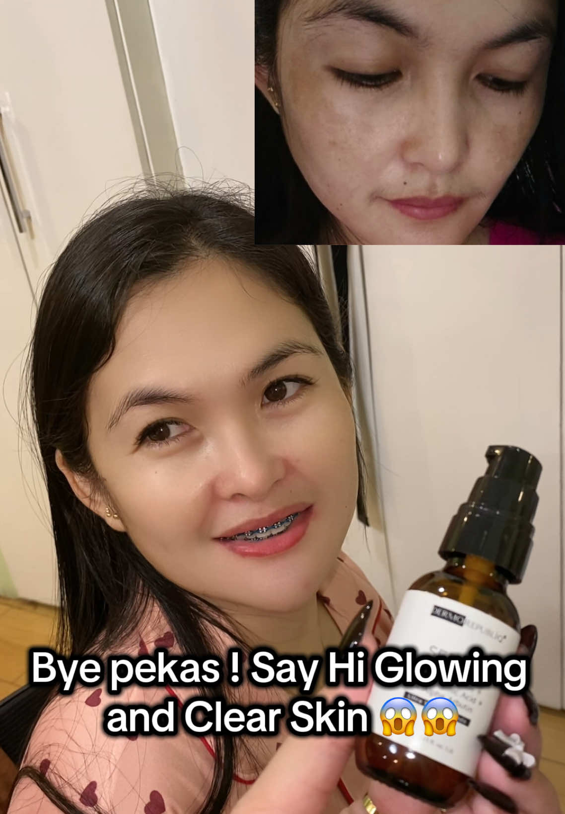 Grabeeee super kinis sa personal tapos yung pekas /dark spots nya nag lighten talaga #dermorepubliqserum  #dermorepubliq  #niacinamideserum  #darkspots #darkspoteraser 
