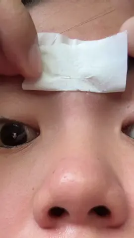 Fav kong blackhead remover “Rtopr Mango” #blackheadremoval #whiteheadremoval #fyp 