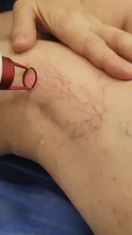 láser NdYAG transdermico# fotocoagulación #flebología estética y funcional#@dravenitas#dradianagiraldovascular#arañitas.Medellín. WhatsApp 300-667-759