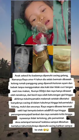 Inalillahi, surga tempatmu nak 🥹... Anak perempuan yg diketahui bernama Raya berumur 4th berasal dari desa kabandungan sukabumi jawabarat. Di dalam tubuh nya di temukan banyak cacing gelang, bahkan hasil CT scan ditemukan ribuan telur cacing yg bersarang di ot** sang anak.  Lebih ngerinya lagi cacing itu keluar dari hidung sang anak , an*s dan kema**an nya. Pelajaran untuk kita para org tua, musibah penyakit tidak ada yg tau. Lebih baik kita mencegah daripada mengobati 🥹🥹🥹. Untuk dek raya surga menantimu nak tenang disana, kamu sudah gak kesa**an lagi. Alfatihah 🤲🤲🤲 #stunting #health #viral #fypシ゚viral  #jawabarat 