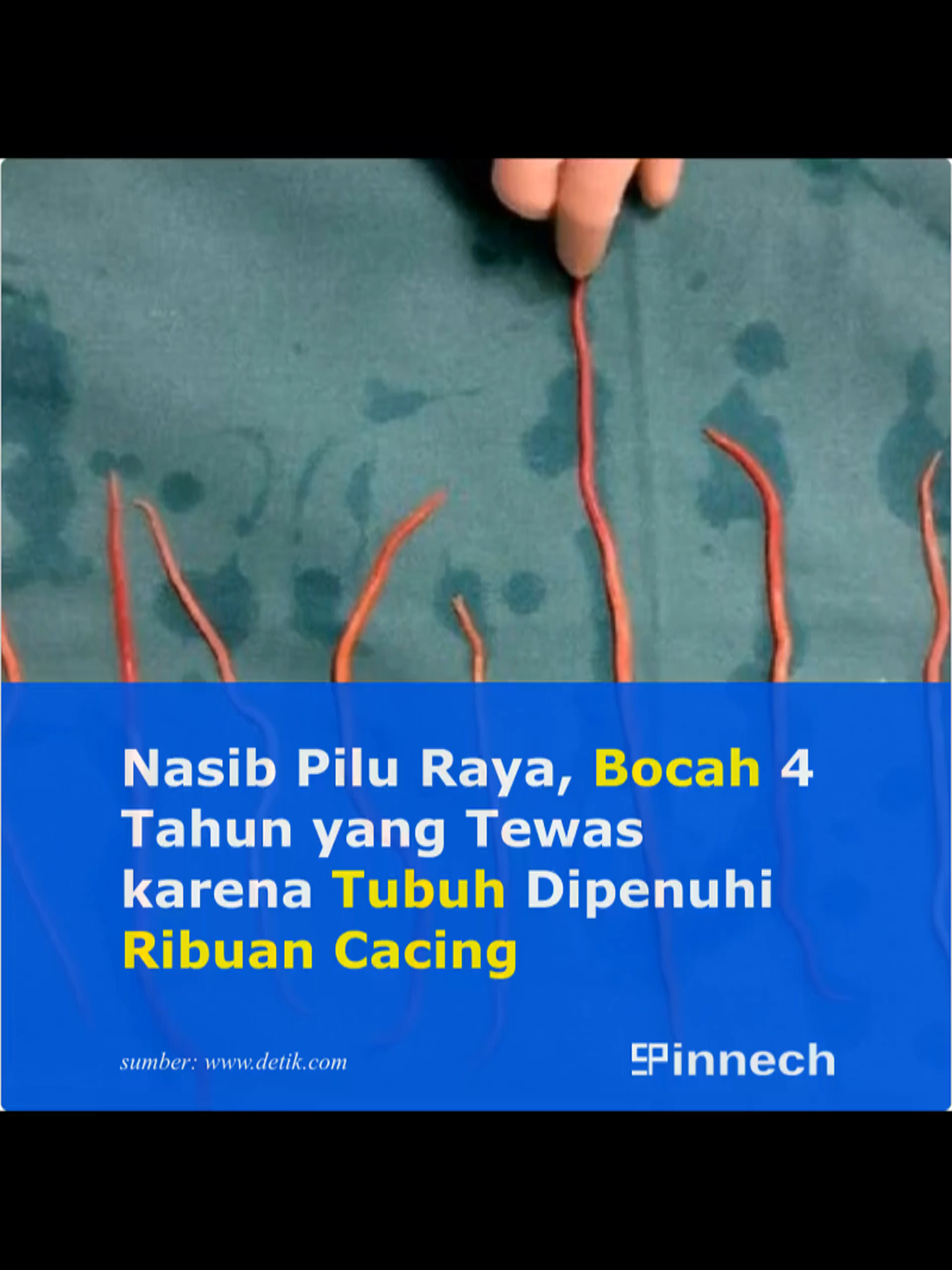 Nasib Pilu Raya, Bocah 4 Tahun yang Tewas karena Tubuh Dipenuhi Ribuan Cacing