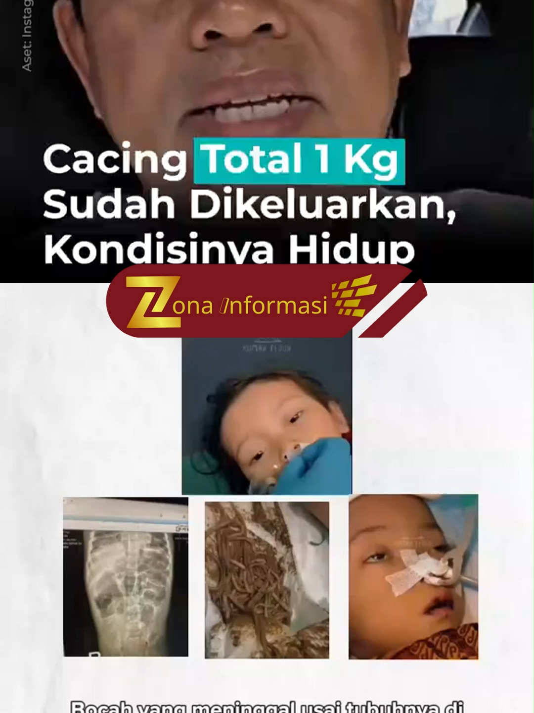 Raya (4), bocah asal Kampung Padangenyang, Sukabumi, meninggal dunia dengan kondisi tubuh dipenuhi cacing. Ia berasal dari keluarga tidak mampu, sang ayah sakit-sakitan sementara ibunya mengalami gangguan jiwa. Mereka tinggal di rumah bilik panggung yang bagian bawahnya dipenuhi kotoran ayam, diduga menjadi sumber infeksi cacing. Raya ditemukan tim pegiat sosial dalam kondisi kritis dan sempat dibawa ke RS. Namun, upaya mencari bantuan biaya medis ke berbagai lembaga pemerintah maupun sosial berakhir nihil. Selama perawatan, dari tubuh Raya dikeluarkan cacing hidup hingga seberat 1 kg, bahkan hasil CT Scan menunjukkan cacing dan telurnya sudah menyebar ke otak. Ia akhirnya meninggal pada 22 Juli 2025. Kasus ini memicu keprihatinan Gubernur Jawa Barat, Dedi Mulyadi. Ia menyebut lingkungan tempat tinggal yang kotor membuat Raya mengalami cacingan akut. Dedi juga menyoroti lemahnya fungsi PKK, posyandu, hingga bidan desa, dan mengancam akan memberi sanksi kepada pihak terkait. Pemerintah provinsi pun mengevakuasi keluarga Raya untuk mendapat perawatan medis karena turut mengidap penyakit TBC.#informasi #FY #fypシ゚viral🖤tiktok #pelajar #tiktoknews #1400