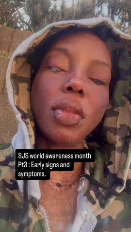Steven Johnson’s awareness month part 3:early signs and symptom’s.  Let me know in the comments what you would like to know .    #fyp #stevenjohnsonawarenessmonth #stevenjohnsonssyndromeawareness 