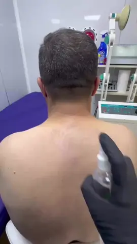 أهم فوائد الحجامة المحتملة: 1. تنشيط الدورة الدموية → تساعد على تحسين تدفق الدم وإيصال الأكسجين والمواد الغذائية للأنسجة. 2. تخفيف الألم → مفيدة لبعض حالات آلام الظهر، الرقبة، الصداع النصفي، والمفاصل. 3. إرخاء العضلات → تقلل من التشنجات العضلية وتحسّن مرونة الأنسجة. 4. دعم المناعة → يعتقد أنها تحفّز الجهاز المناعي وتزيد من مقاومة الأمراض. 5. إزالة السموم → الحجامة الرطبة قد تساعد الجسم على التخلص من بعض الفضلات والشوائب. 6. تخفيف التوتر والقلق → كثير من الأشخاص يشعرون بالراحة والاسترخاء بعدها. #هەولێر #هەولێر_سلێمانی_دەهۆک_ڕانیه_کەرکوک #سلێمانی_هەولێر_کەرکوک_دهۆک #سلێمانی_هەولێر_کەرکوک_دهۆک #دەرزی_ئاژنین 