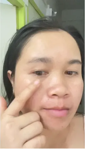 ย้อนเวลาไปได้จะได้บีบสิวให้หน้าเป็นรอยแบบนี้#ลัดดาบิวตี้ #icelerskin #เชรั่มแต้มสิว #ใช้ดีบอกต่อ #ของดีบอกต่อ #tiktokป้ายยา #tiktokshop #tiktokshopครีเอเตอร์ 