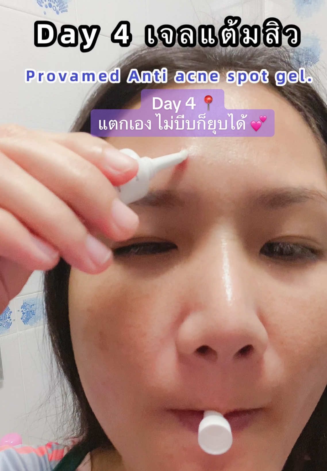 สรุป: ไม่ต้องรีดออกเอง  แค่ซับออกเบา ๆ แล้วแต้มยาก็พอค่ะ  Day 4 🧖🏻‍♀️ วันนี้สิวอักเสบแตกเองแล้วค่ะ ไม่ได้บีบ ไม่ได้แกะ แต่ยังต้องดูแลต่อด้วยเจลแต้มสิว เพื่อให้แผลสะอาด สิวยุบไว และไม่ทิ้งรอย 🩹✨  