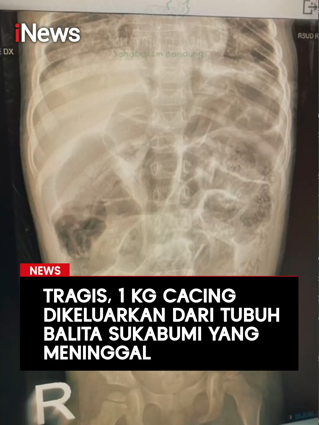Sukabumi digemparkan dengan kabar meninggalnya Raya (4), seorang balita asal Kampung Padangenyang, akibat infeksi cacing gelang atau ascaris. Korban sempat dirawat di RSUD R Syamsudin SH Kota Sukabumi sejak 13 Juli 2025 dalam kondisi tidak sadar. Selama perawatan, dokter mendapati cacing berukuran besar keluar dari hidung dan fesesnya, sementara infeksi sudah menyebar hingga paru-paru dan otak. Kasus ini bermula dari telur cacing yang masuk lewat makanan atau tangan yang terkontaminasi tanah di sekitar rumah panggung tempat tinggal korban. Setelah sembilan hari berjuang di ruang PICU, Raya meninggal dunia pada 22 Juli 2025. Tragedi ini menjadi pengingat pentingnya menjaga kebersihan lingkungan, sanitasi, serta pemeriksaan kesehatan anak secara rutin untuk mencegah cacingan akut. #Sukabumi #CacinganAkut #KesehatanAnak #WaspadaInfeksi