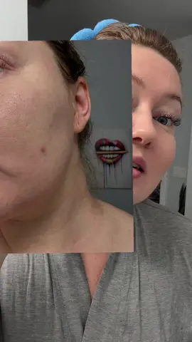 Gets your pimples go away in a day! #pimple #a313 #getridofpimples #skincare #skincareroutine 