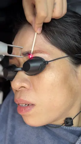 Tặng các chị em clip xoá ra màu đỏ nha#batrumchanmaytrangbom #phunxamtrangbom #Phunxamanhvi #xoaxamlaser #xoalaser #xoachanmay 