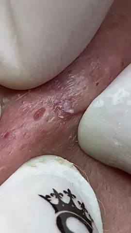 #spa #beautify #squeezingpimples #skincare #asmr 