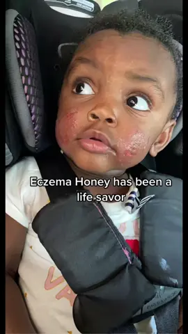 Eczema honey has been a life saver! #tiktokshop #eczemahoney 
