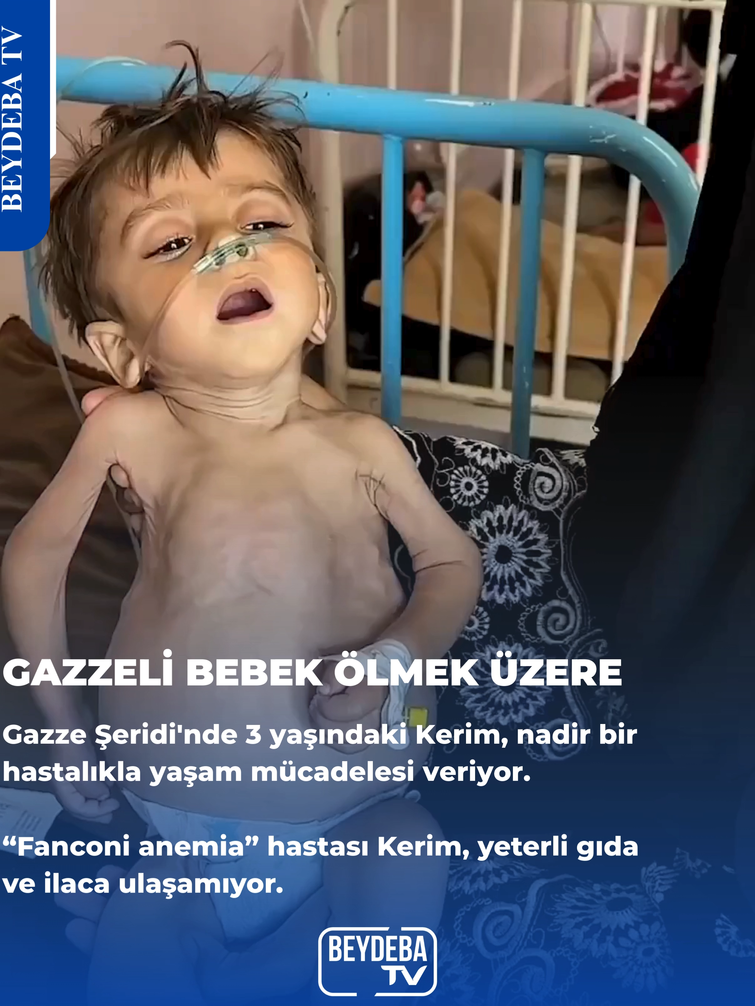 Gazze Şeridi'nde 3 yaşındaki Kerim, nadir bir hastalıkla yaşam mücadelesi veriyor. #fyf #türkiyem #gazze #filistin