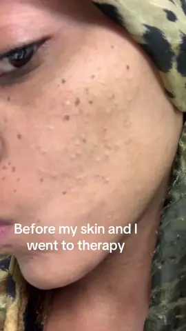 Not me acting like hot water and vibes was a skincare routine 💀 