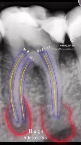 Endo motion 🪄.                                #endomotion #endo #fyp#viral#motiondesign #dentalmotiongraphics 