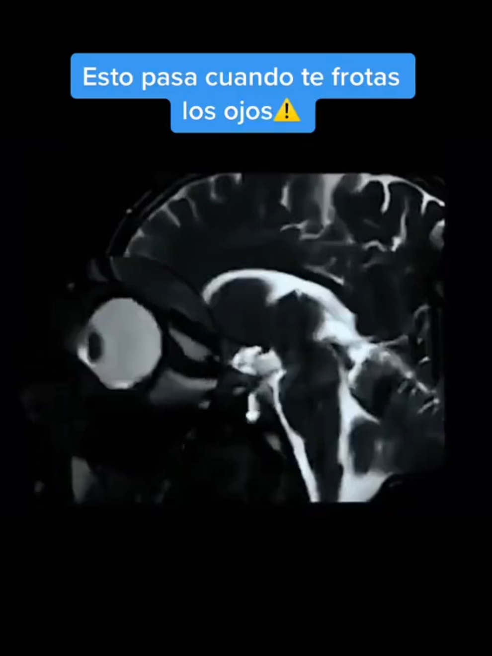 Evite frotarse los ojos 🫣👀🙅‍♂️ #optometria🤓 #oftalmologia #saludvisual #sigueme #like 