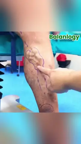 Revolutionary FDA-approved spray eliminates varicose veins in just 7 days – no surgery！