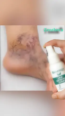 Revolutionary FDA-approved spray eliminates varicose veins in just 7 days – no surgery！