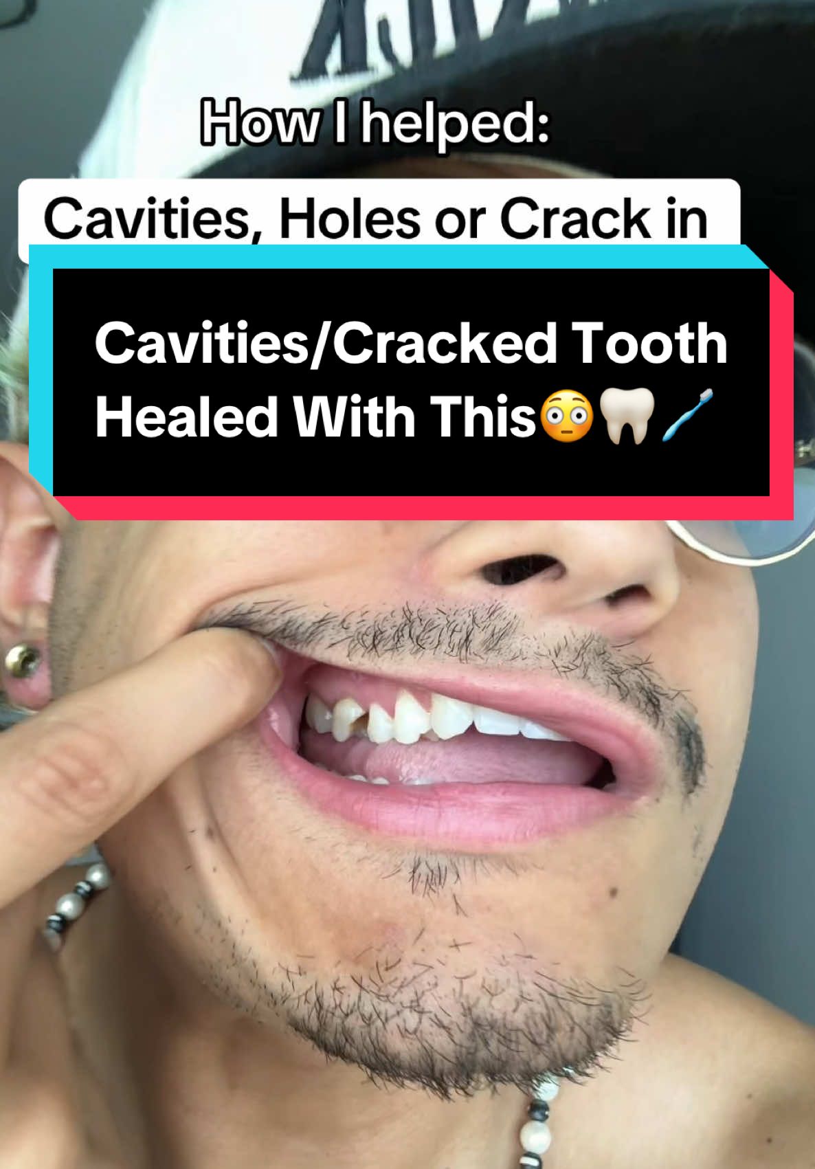 How I helped my broken tooth with cavities😳🙏🏼🦷 #cavities #teeth #tooth #nobs #toothpastetablets 