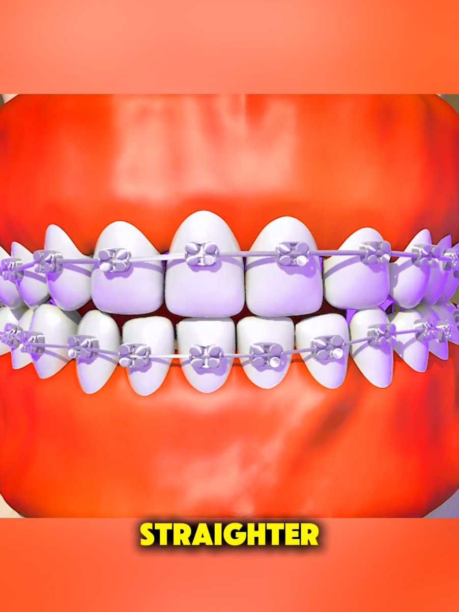 How Braces Are Put On (3D Animation) #3dmedicalanimation  #medical3danimation  #braces  #orthodontics  #dentalbraces 