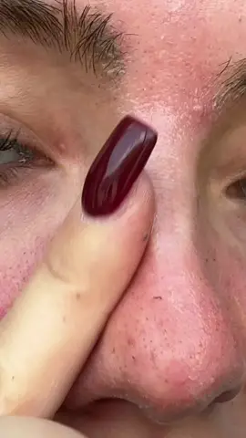 this literally got rid of my blackheads and my whiteheads and my pores look so much better #drmelaxin #drmelaxinpeelshot #peelshot #blackhead #skincare 
