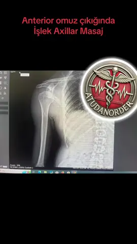 Merhaba arkadaşlar Ana Acil bültenine hoş geldiniz 🤗  Çok mutluyum çok!!!!  Bana gelen ilk Atu omuz redüksiyonu videosu Hatay’dan ahiretliğim Eylem gümüş Kantarcı’dan geldi. Ellerine sağlık eylemciğim🥰 Hep beraber çok güzeliz. İyi ki varsınız🥰   Acil servisde ağrısız acısız traksiyonsuz ilaçsız sadece masaj ile çok kısa sürede redüksiyon sağlarız işlek Axillar masaj ile Anterior omuz çıkığında🥰 Hastalar mutlu uygulayıcılar daha da mutlu🥰 Sedasyon vermediğimiz için tabırculuk süreside kısalıyor. (Omuz redüksiyonunda Sedasyon verdiğimiz hastaları kırmızı alanda bir saat takip etmek zorunda kalıyorduk:) Ben en fazla 3 dkka masaj yapıyorum. Eğer 3 dkka içerisinde redükte olmuyorsa Sedasyon verip traksiyonlu işlemlere geçiyoruz. Ben traksiyonlu yöntemlerden en çok FARES tekniğini seviyorum. Resmen çocukluğuma dönüyorum🥰    Sizler de en sevdiğiniz teknikleri bizimle paylaşabilirsiniz🥰  #acilservis #işlekaxillarmasaj #işlekaxillarmassage #shoulderreduction #shoulderreductiontechnique   